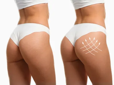 Hip Augmentation