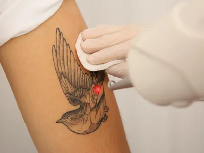 Tattoo Removal