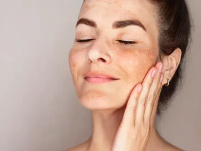 Melasma Treatment